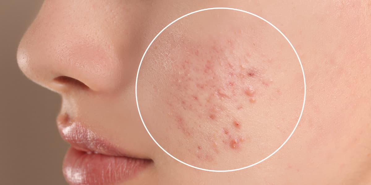Acne-Treatments-Advice